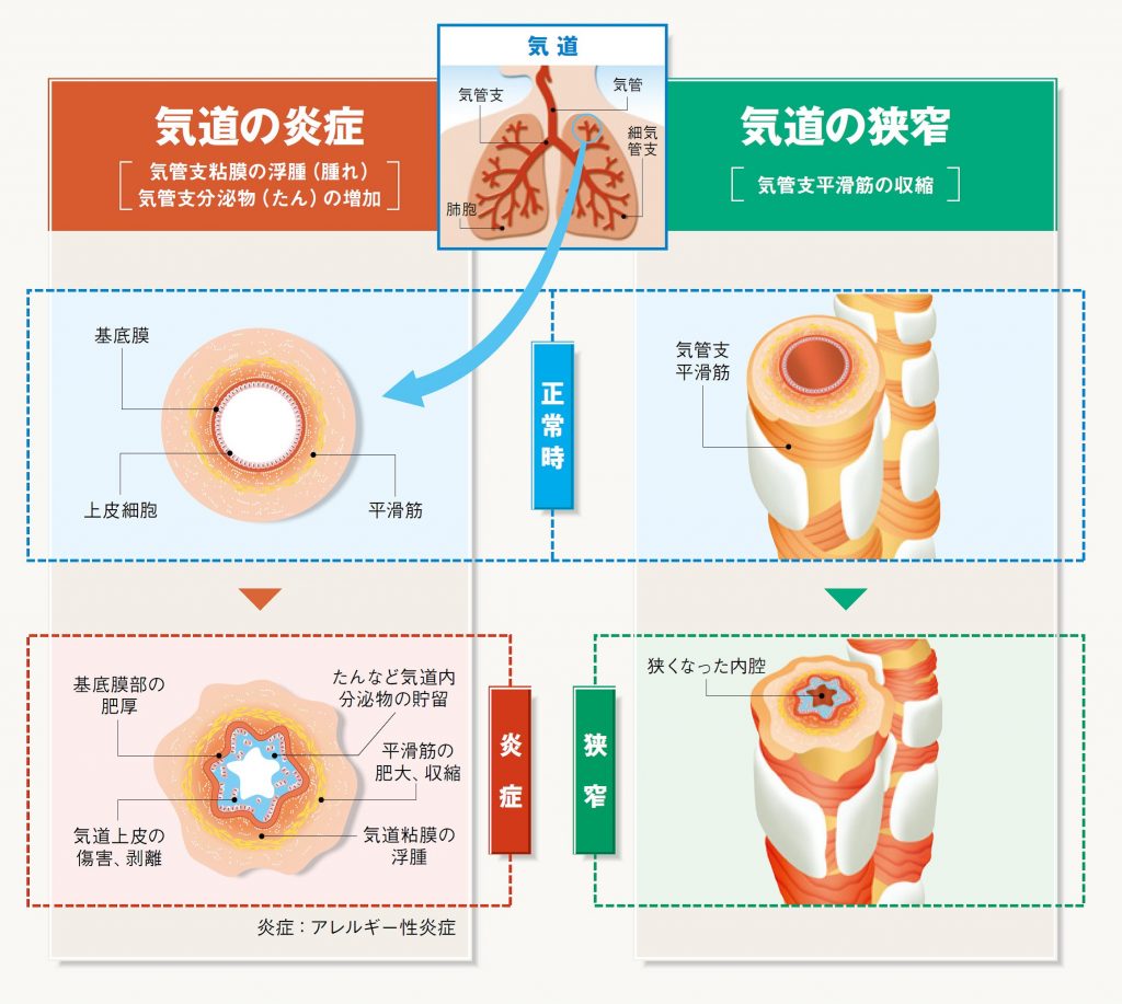 気管支喘息 | 印西そよかぜ内科・呼吸器内科